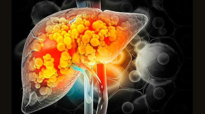 Especialistas del CONICET analizan en <i>Cell</i> las perspectivas del primer fármaco para tratar la enfermedad del hígado graso en su estadio más avanzado